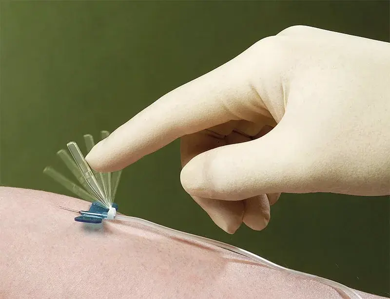 Microperfuseur à ailettes sécurisé Surshield®