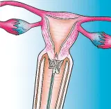 Vignette - Brosse à prélèvement Cervex Brush®